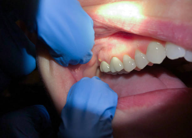 Best Emergency Treatment for Dental Infections or Abscesses in Start, LA