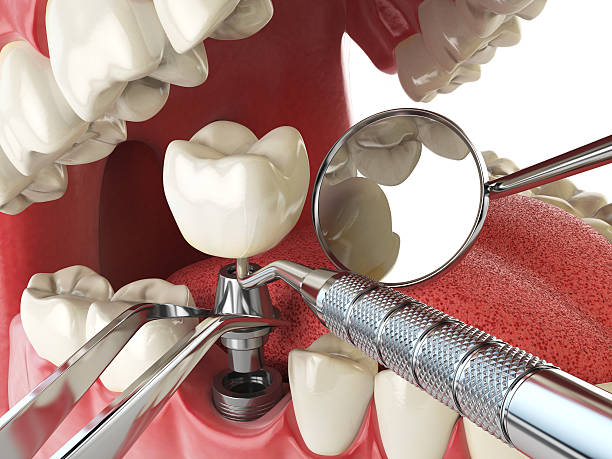 Best Emergency Dental Care for Broken or Chipped Teeth in Start, LA